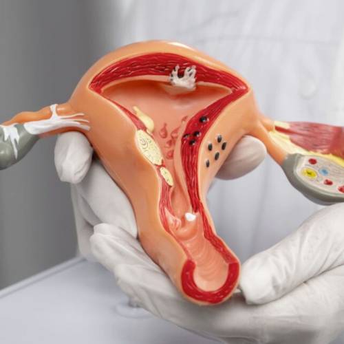 Curso Endometriosis • Sin Membresía ALAPP